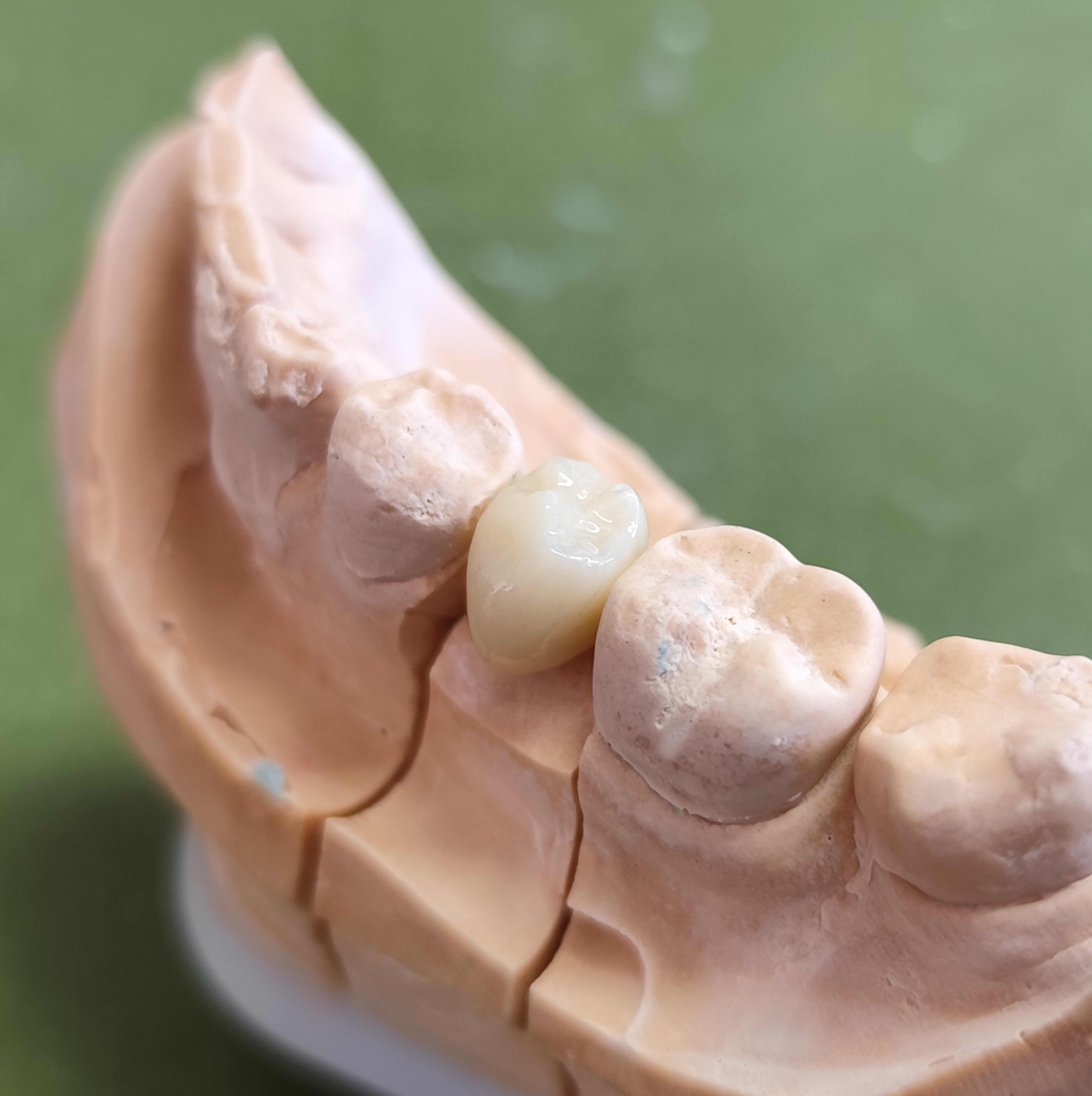 Couronne dentaire en céramique haute qualité